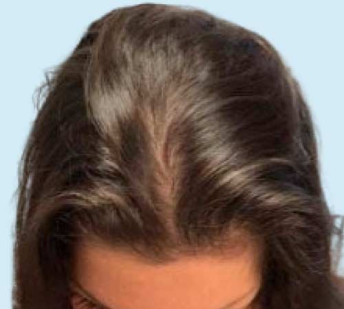 La micropigmentacion para pelo en mujeres caso 5 antes del tratamiento DE MICRO