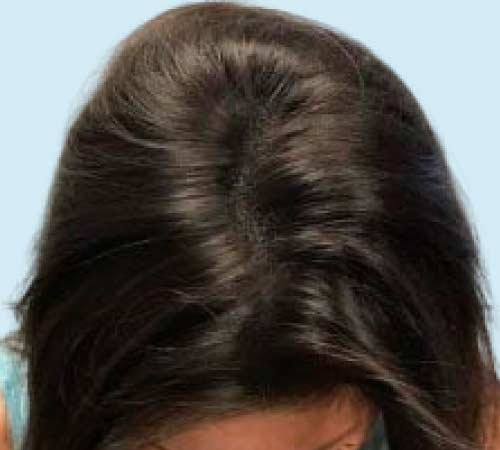 La micropigmentacion para pelo en mujeres caso 5 despues del tratamiento DE MICRO