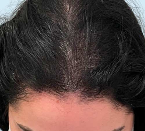 Mayor cantidad de pelo con micro capilar en mujeres caso 4 despues del tratamiento