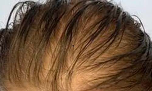 Micropigmentacion capilar de pelo largo caso 1 antes del tratamiento