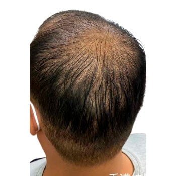 Micropigmentacion capilar para personas con pelo largo