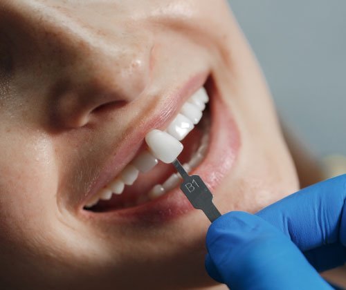 Paciente con carillas dentales